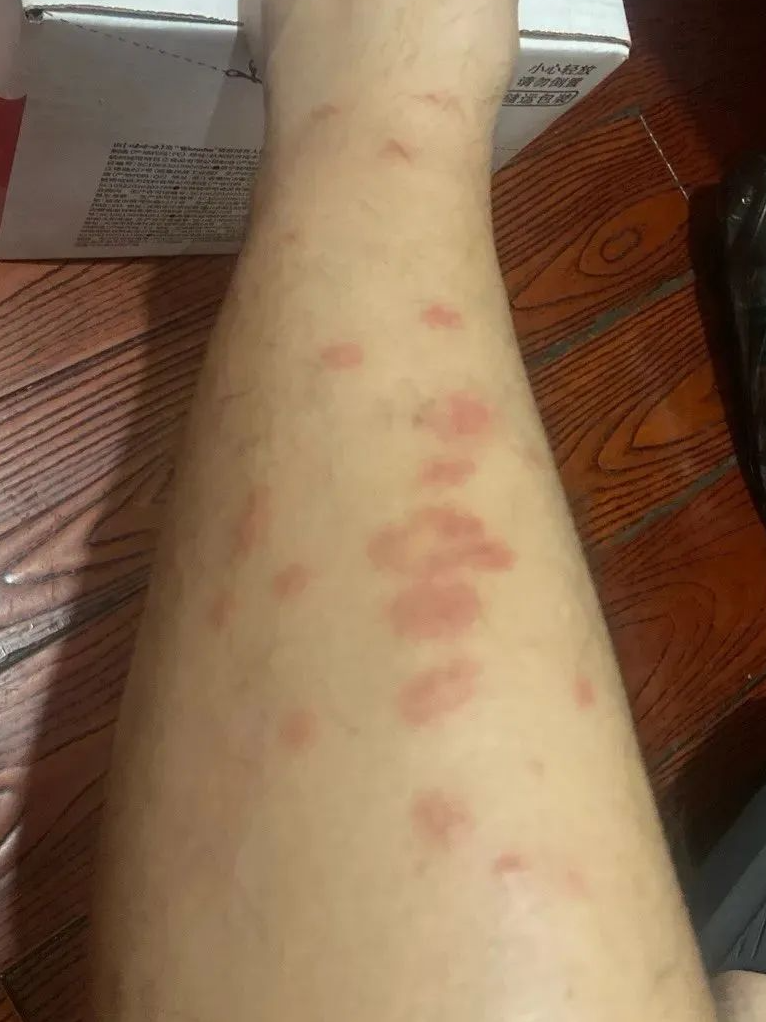 突发红斑又会消失，突发红斑瘙痒无比是怎么了 